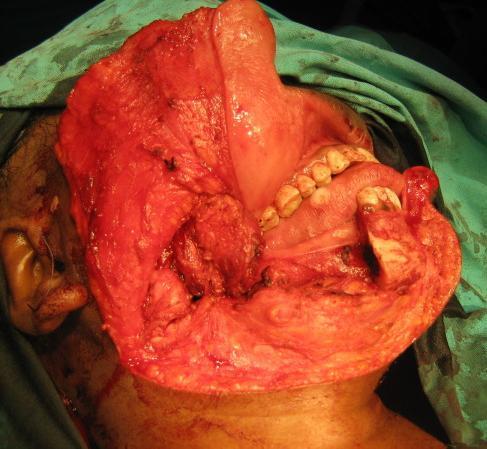 https://cdn.ncbi.nlm.nih.gov/pmc/blobs/4012/2821325/dff33b44f6a3/1758-3284-2-1-5.jpg