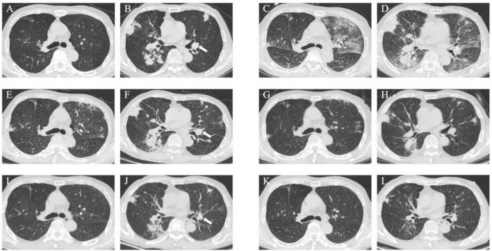 https://cdn.ncbi.nlm.nih.gov/pmc/blobs/403c/12066253/61b1e1d64fd5/fmed-12-1565071-g001.jpg