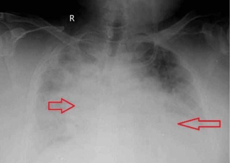 https://cdn.ncbi.nlm.nih.gov/pmc/blobs/4045/10636283/4c9208dc7c3b/cureus-0015-00000046818-i01.jpg