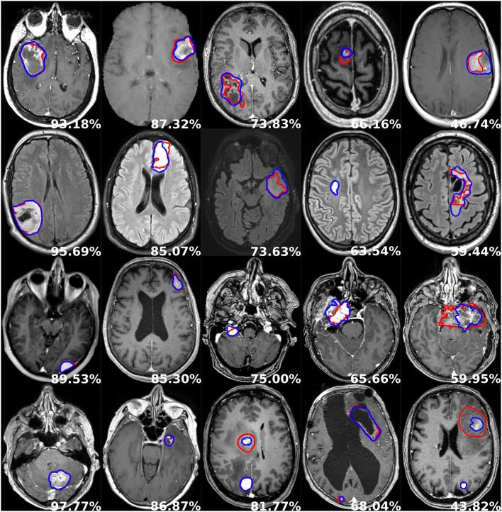 https://cdn.ncbi.nlm.nih.gov/pmc/blobs/40a8/9364874/1259a21f9287/fneur-13-932219-g0005.jpg