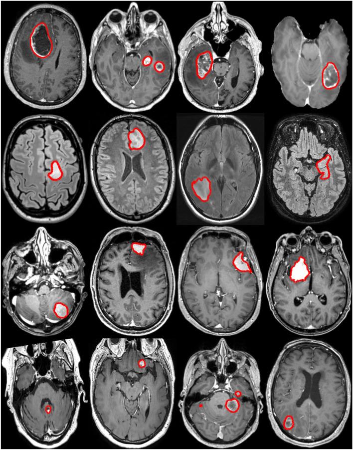 https://cdn.ncbi.nlm.nih.gov/pmc/blobs/40a8/9364874/94577e503274/fneur-13-932219-g0001.jpg