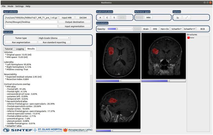 https://cdn.ncbi.nlm.nih.gov/pmc/blobs/40a8/9364874/deec3c2657f1/fneur-13-932219-g0002.jpg