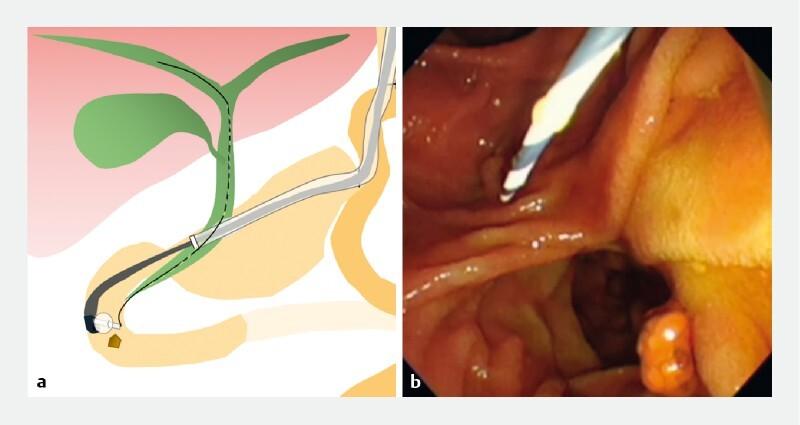 https://cdn.ncbi.nlm.nih.gov/pmc/blobs/40a9/10442208/5ed1c604ecdf/10-1055-a-2145-1671-i4129ev5.jpg