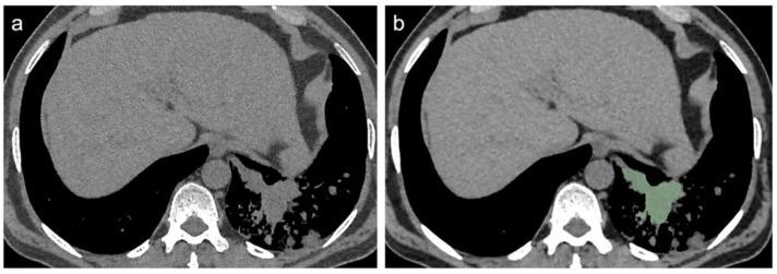 https://cdn.ncbi.nlm.nih.gov/pmc/blobs/40cf/8947348/e3f190203005/diagnostics-12-00739-g005.jpg