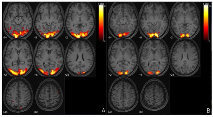 https://cdn.ncbi.nlm.nih.gov/pmc/blobs/4104/11858725/30618fc9a755/neurolint-17-00015-g004.jpg