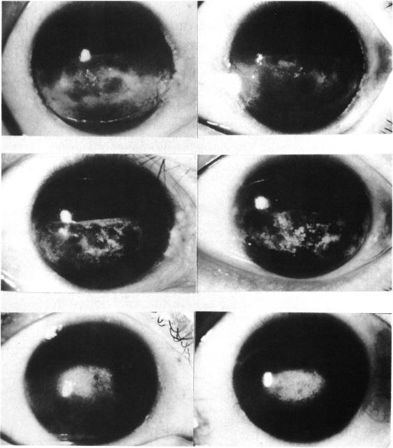 https://cdn.ncbi.nlm.nih.gov/pmc/blobs/414d/1041014/c3f22ba7184e/brjopthal00627-0029-a.jpg