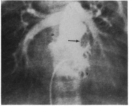 https://cdn.ncbi.nlm.nih.gov/pmc/blobs/414f/482007/3152d96276ad/brheartj00203-0019-a.jpg