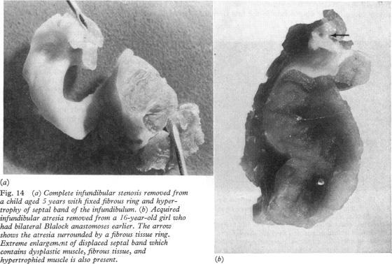 https://cdn.ncbi.nlm.nih.gov/pmc/blobs/414f/482007/607dea0d5339/brheartj00203-0018-a.jpg