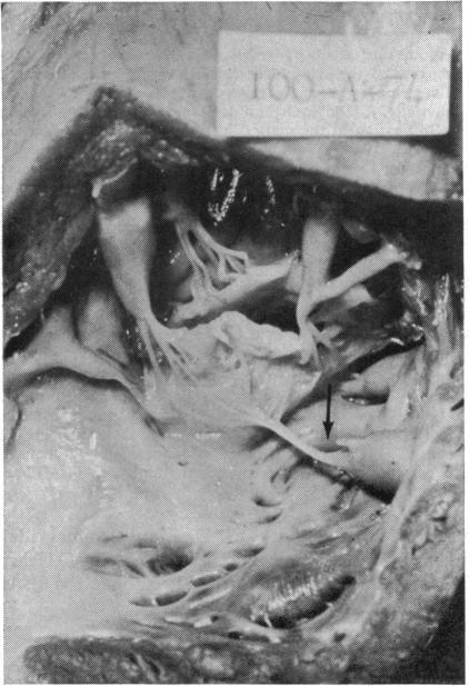 https://cdn.ncbi.nlm.nih.gov/pmc/blobs/414f/482007/9b1d59dc574a/brheartj00203-0028-a.jpg