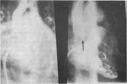 https://cdn.ncbi.nlm.nih.gov/pmc/blobs/414f/482007/acc5907b6558/brheartj00203-0026-a.jpg
