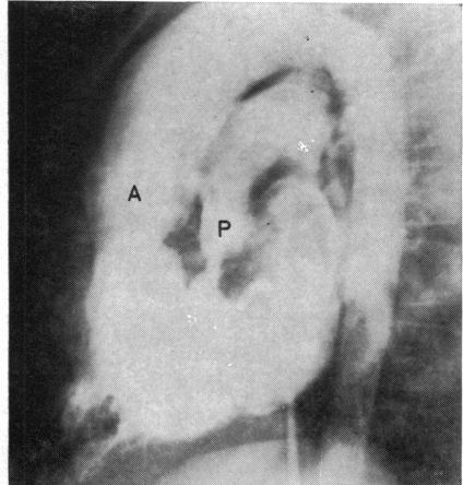 https://cdn.ncbi.nlm.nih.gov/pmc/blobs/414f/482007/d16d013e9b23/brheartj00203-0020-a.jpg
