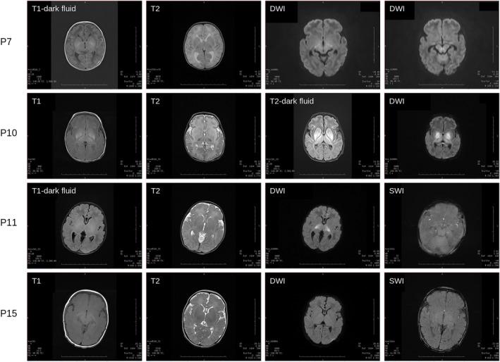 https://cdn.ncbi.nlm.nih.gov/pmc/blobs/41a9/10795097/57d9da46fe59/MGG3-12-e2354-g001.jpg