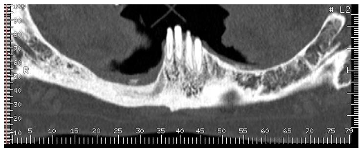 https://cdn.ncbi.nlm.nih.gov/pmc/blobs/41c1/5806981/452cc530196f/dentistry-05-00013-g013.jpg