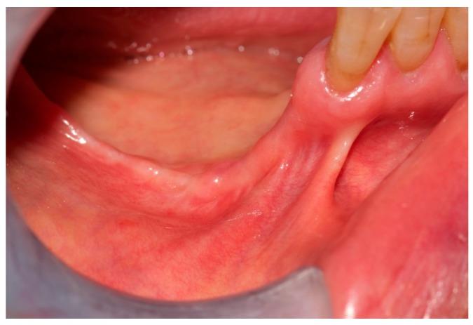 https://cdn.ncbi.nlm.nih.gov/pmc/blobs/41c1/5806981/7e1a7fc331d1/dentistry-05-00013-g008.jpg