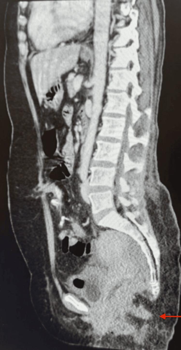 https://cdn.ncbi.nlm.nih.gov/pmc/blobs/429a/12117281/eb528954ba58/cureus-0017-00000083104-i05.jpg