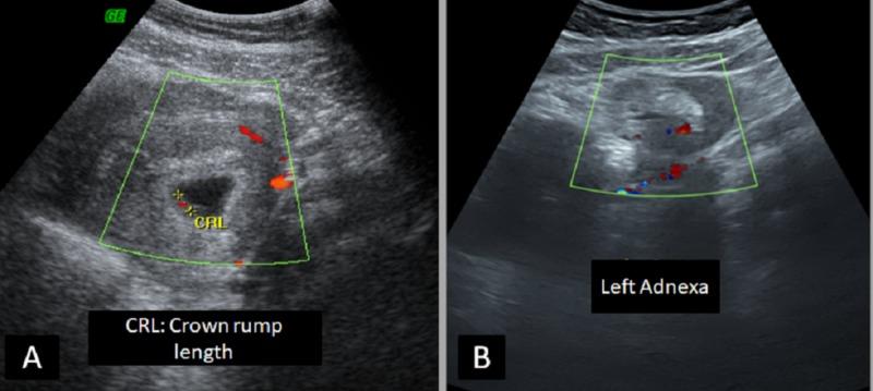 https://cdn.ncbi.nlm.nih.gov/pmc/blobs/42b8/6894893/70d04756ca88/cureus-0011-00000006080-i06.jpg