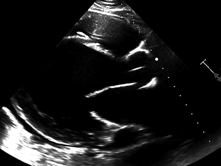 https://cdn.ncbi.nlm.nih.gov/pmc/blobs/42c5/11222018/8e340314ae29/cureus-0016-00000061615-i02.jpg