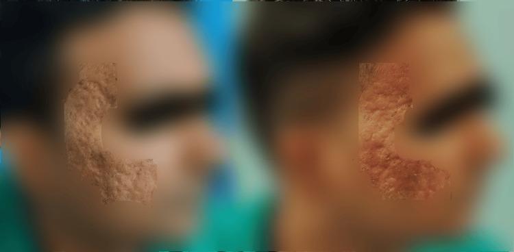 https://cdn.ncbi.nlm.nih.gov/pmc/blobs/42eb/11096773/83898f717a49/cureus-0016-00000058358-i02.jpg