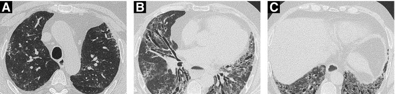 https://cdn.ncbi.nlm.nih.gov/pmc/blobs/4319/7068837/5a760336ae9a/rccm.201903-0563CI_f4.jpg