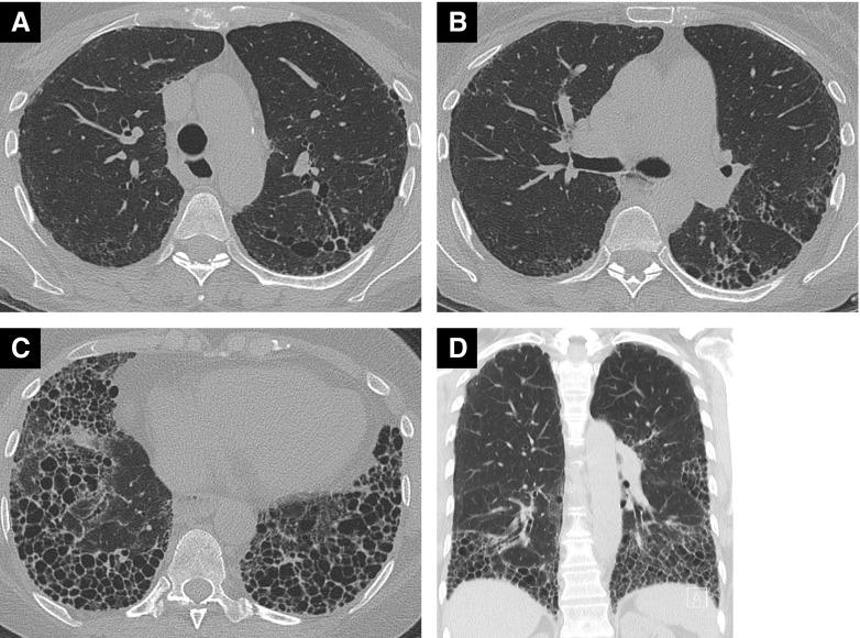 https://cdn.ncbi.nlm.nih.gov/pmc/blobs/4319/7068837/e8dc6881f33e/rccm.201903-0563CI_f3.jpg