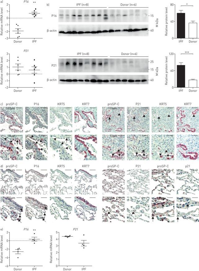 https://cdn.ncbi.nlm.nih.gov/pmc/blobs/436c/5593348/2c06003083bb/ERJ-02367-2016.01.jpg