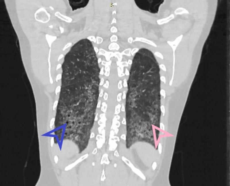https://cdn.ncbi.nlm.nih.gov/pmc/blobs/437a/7053681/96553d44eab6/cureus-0012-00000006875-i04.jpg