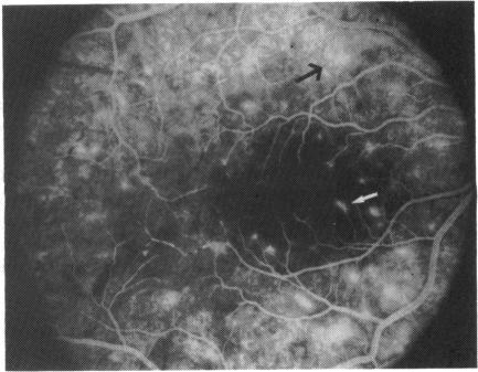 https://cdn.ncbi.nlm.nih.gov/pmc/blobs/4383/1041638/ad362eb45cef/brjopthal00593-0044-a.jpg