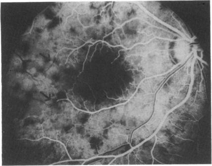 https://cdn.ncbi.nlm.nih.gov/pmc/blobs/4383/1041638/f1ac41216b71/brjopthal00593-0044-b.jpg