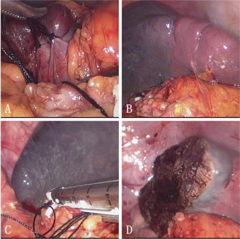 https://cdn.ncbi.nlm.nih.gov/pmc/blobs/43d5/5406050/5fca7109cc28/medi-96-e6450-g001.jpg