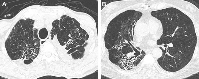 https://cdn.ncbi.nlm.nih.gov/pmc/blobs/43dc/5841335/19d4ae0cacd4/copd-13-761Fig3.jpg