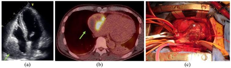 https://cdn.ncbi.nlm.nih.gov/pmc/blobs/43ea/6546942/724cbfb6b8e7/10.1177_2632010X19831261-fig1.jpg