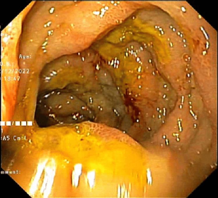 https://cdn.ncbi.nlm.nih.gov/pmc/blobs/4438/11143767/1811d7925b39/cureus-0016-00000059508-i04.jpg