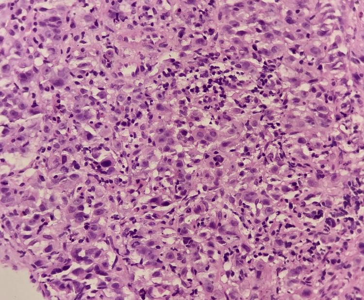 https://cdn.ncbi.nlm.nih.gov/pmc/blobs/4438/11143767/1c28975f1705/cureus-0016-00000059508-i08.jpg