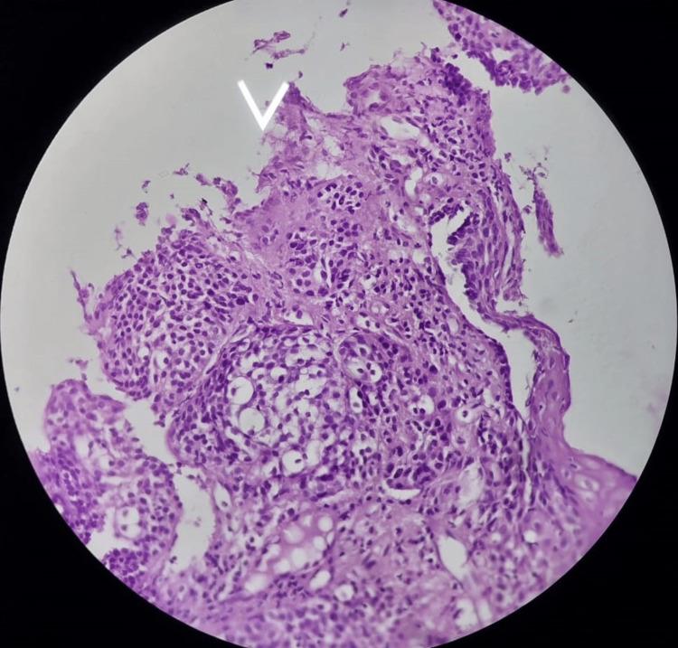 https://cdn.ncbi.nlm.nih.gov/pmc/blobs/4438/11143767/b83143625924/cureus-0016-00000059508-i05.jpg