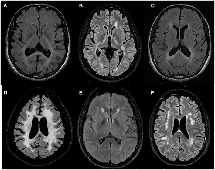 https://cdn.ncbi.nlm.nih.gov/pmc/blobs/44ba/9359417/f4991d8b5065/fneur-13-928493-g0003.jpg