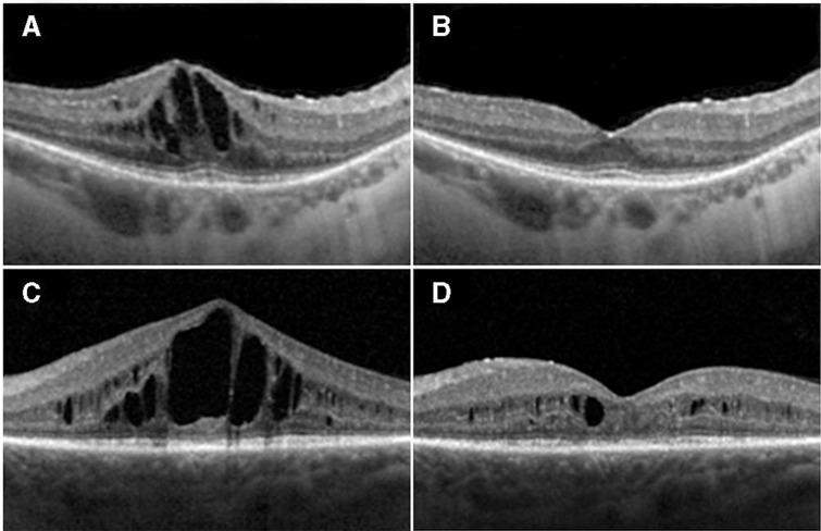 https://cdn.ncbi.nlm.nih.gov/pmc/blobs/44c6/7577098/9bd209151e2b/bjophthalmol-2019-315152f02.jpg