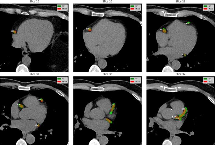 https://cdn.ncbi.nlm.nih.gov/pmc/blobs/451e/12034606/5d859f484fdd/40658_2025_751_Fig2_HTML.jpg