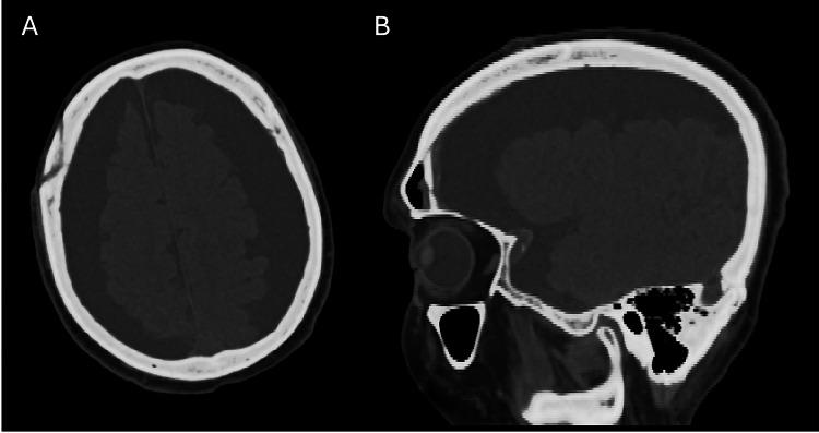 https://cdn.ncbi.nlm.nih.gov/pmc/blobs/4520/11465702/9f32fa18c0a8/cureus-0016-00000069070-i01.jpg