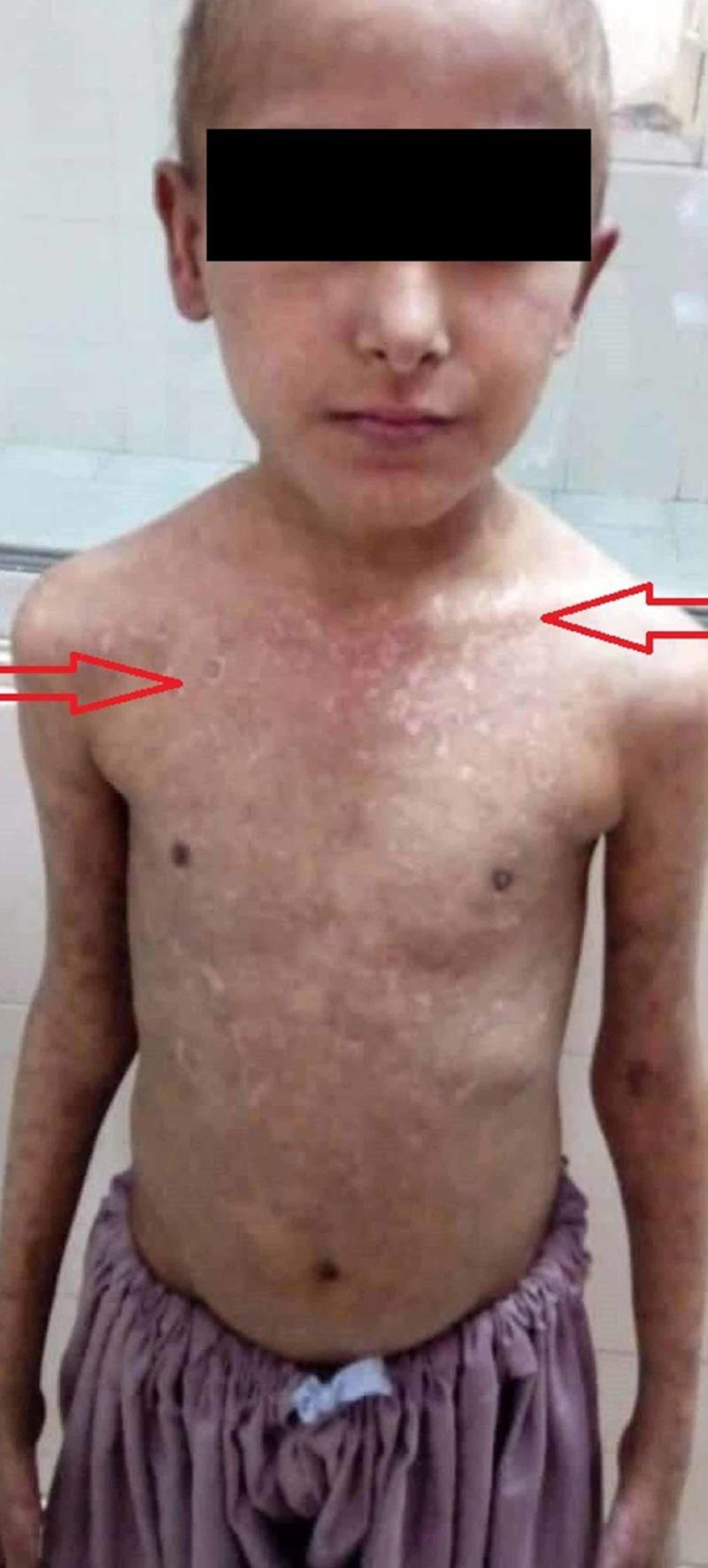 https://cdn.ncbi.nlm.nih.gov/pmc/blobs/4534/6609278/834b98714662/cureus-0011-00000004604-i01.jpg