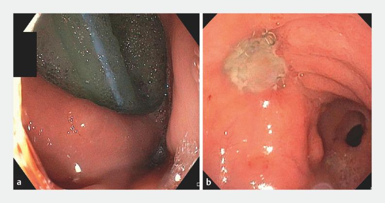 https://cdn.ncbi.nlm.nih.gov/pmc/blobs/453d/11136556/2ef3a5d8863a/10-1055-a-2320-1970_23202501.jpg