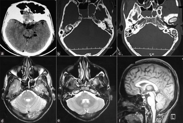 https://cdn.ncbi.nlm.nih.gov/pmc/blobs/4541/4974977/9239e4abe7e8/AJNS-11-446a-g002.jpg