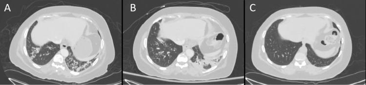 https://cdn.ncbi.nlm.nih.gov/pmc/blobs/4559/9710296/12c18bbdd6f4/cureus-0014-00000030908-i01.jpg