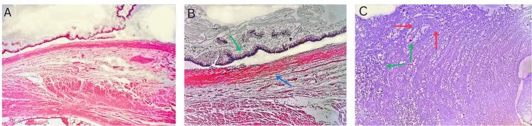 https://cdn.ncbi.nlm.nih.gov/pmc/blobs/455a/11263967/76bc1a2492dd/cureus-0016-00000065168-i03.jpg