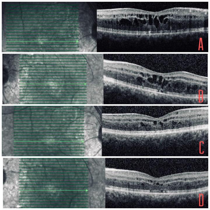 https://cdn.ncbi.nlm.nih.gov/pmc/blobs/4573/7339689/d7559238f9f0/RomJOphthalmol-64-213-g002.jpg