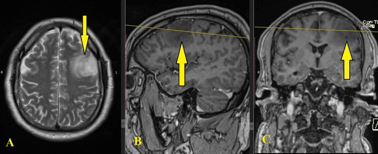 https://cdn.ncbi.nlm.nih.gov/pmc/blobs/45a4/11149057/9c505a405df4/cureus-0016-00000059667-i01.jpg