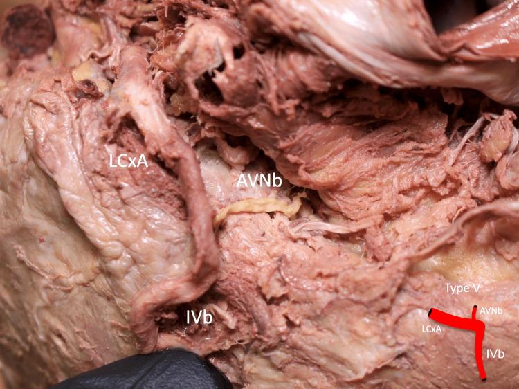 https://cdn.ncbi.nlm.nih.gov/pmc/blobs/45ae/10042528/3f5ec42b90f3/cureus-0015-00000035412-i06.jpg