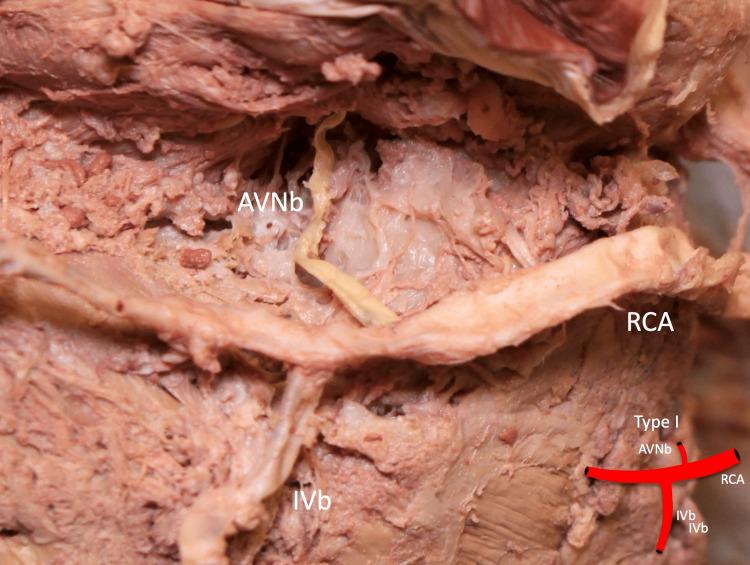 https://cdn.ncbi.nlm.nih.gov/pmc/blobs/45ae/10042528/beeab77c440c/cureus-0015-00000035412-i02.jpg