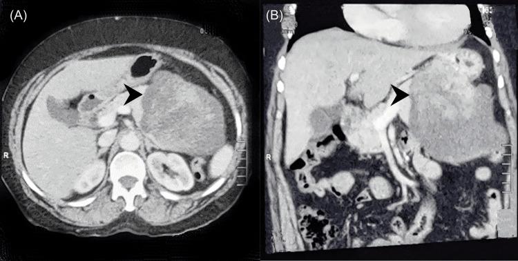 https://cdn.ncbi.nlm.nih.gov/pmc/blobs/45b8/10275745/9e75baac13b8/cureus-0015-00000039162-i01.jpg