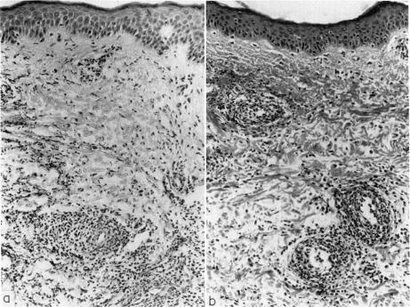 https://cdn.ncbi.nlm.nih.gov/pmc/blobs/45c6/1713020/fdad7618c61e/clinexpimmunol00369-0048-a.jpg