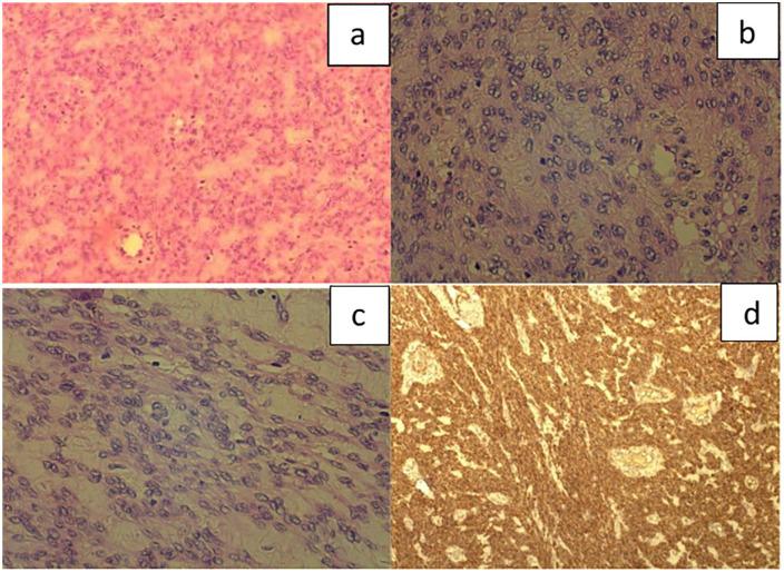 https://cdn.ncbi.nlm.nih.gov/pmc/blobs/4616/8107659/b526bcba9d36/10.1177_2050313X211012516-fig3.jpg